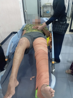 Jalan Berlubang di Sempu Kembali Makan Korban, Dinas PUCKPP Didesak Bertindak